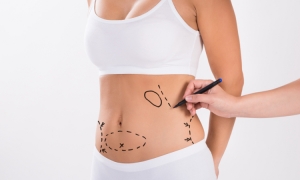 Na jakich obszarach ciała można przeprowadzić liposukcję